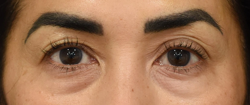 Eyelid Surgery Patient 15 Set 1 Before